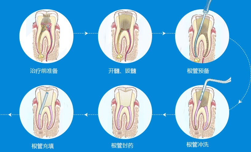 后牙做显微根管治疗多少钱？