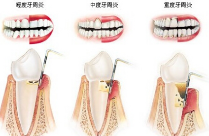 牙周炎怎么治疗？